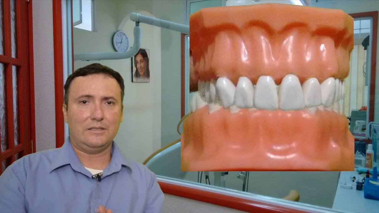 Oclusión Overbite