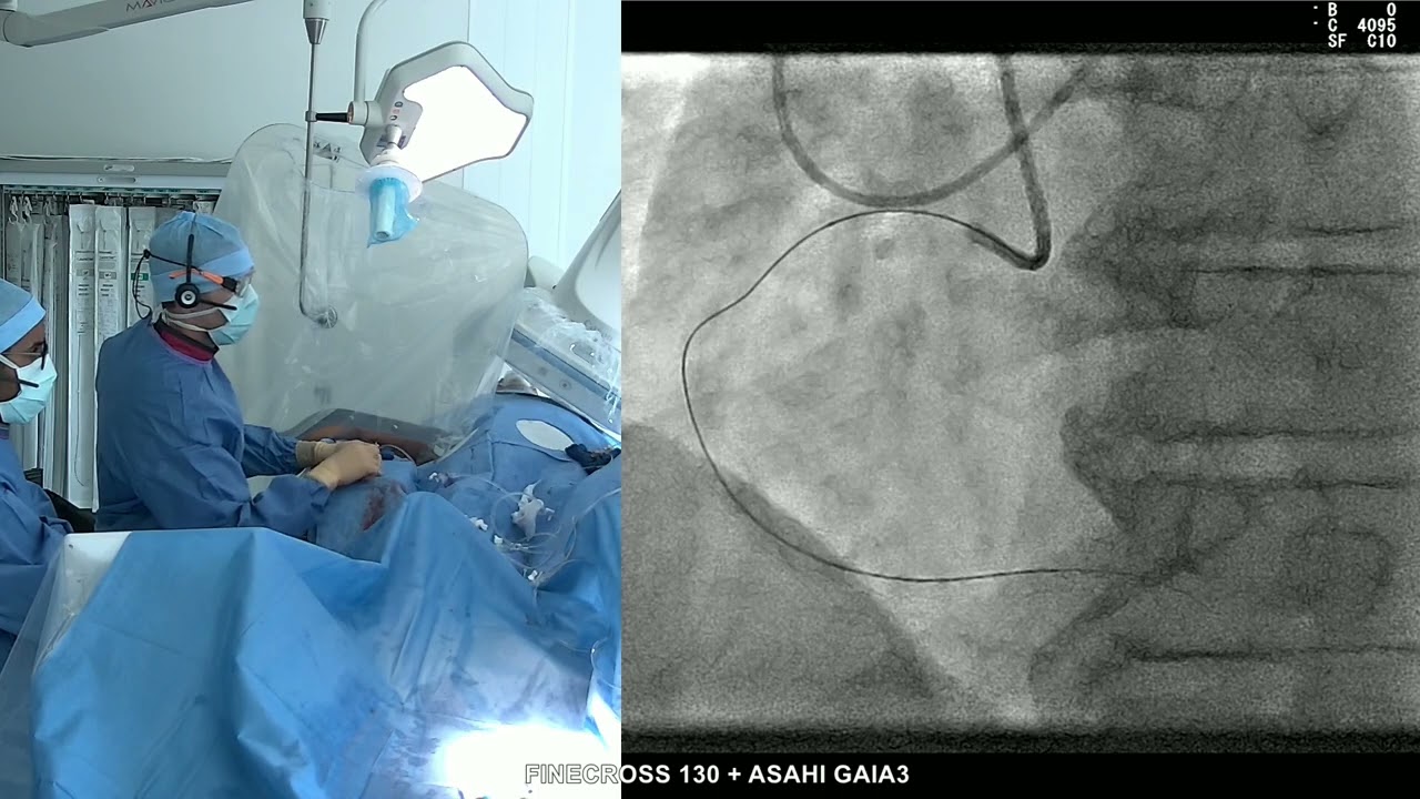 cto cd antero gaia3 finecross DR ROBIN