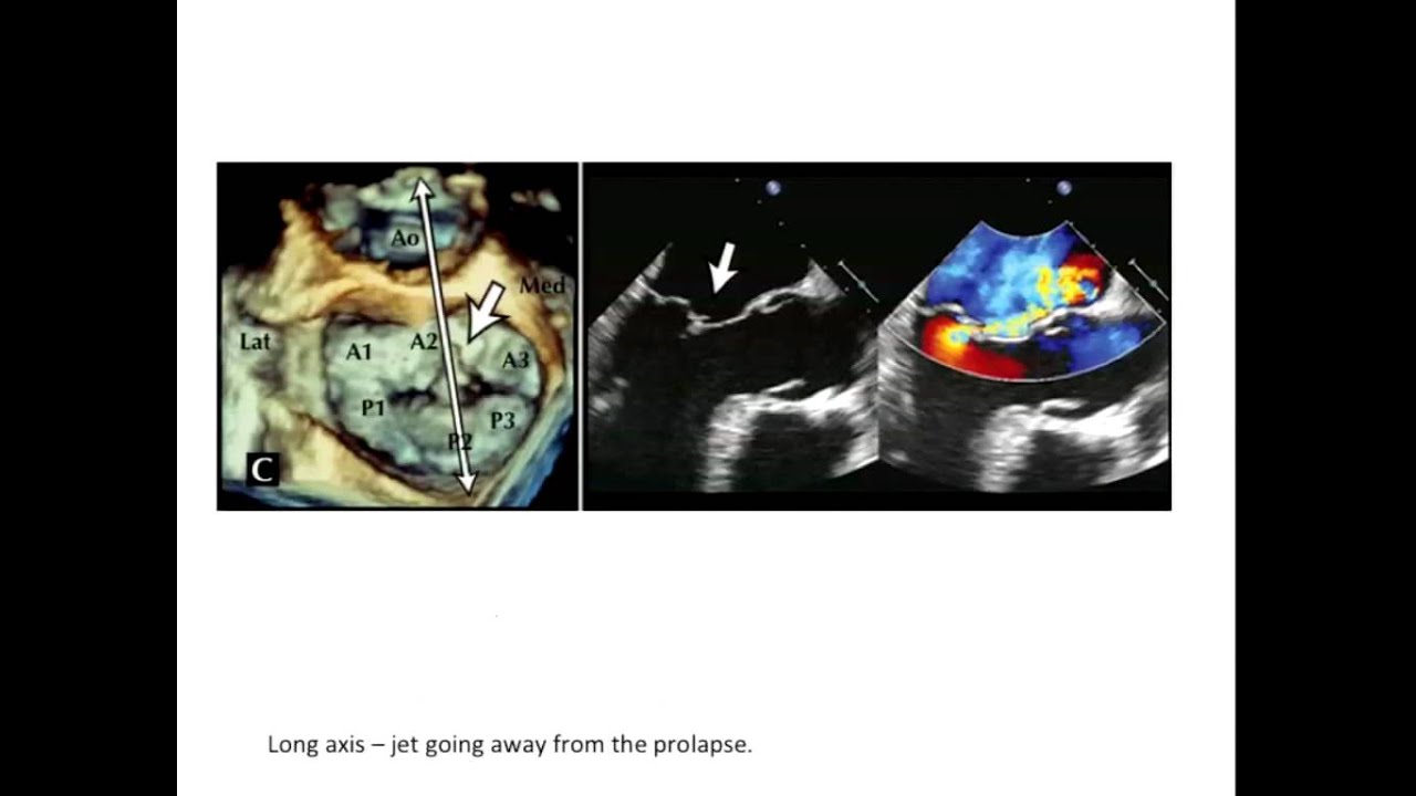 Dr Jason Kaplan: 3D Echocardiographic Assessment of Mitral Valve Disease
