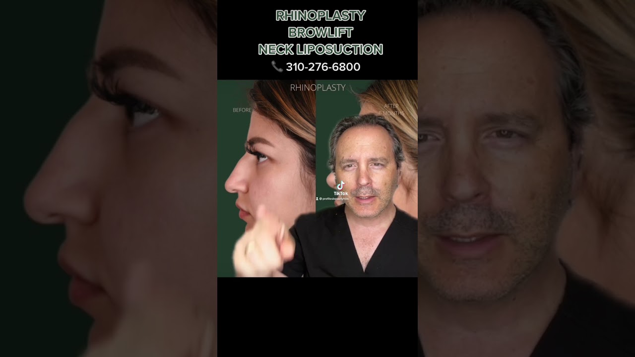 Rhinoplasty, Browlift, Neck Liposuction