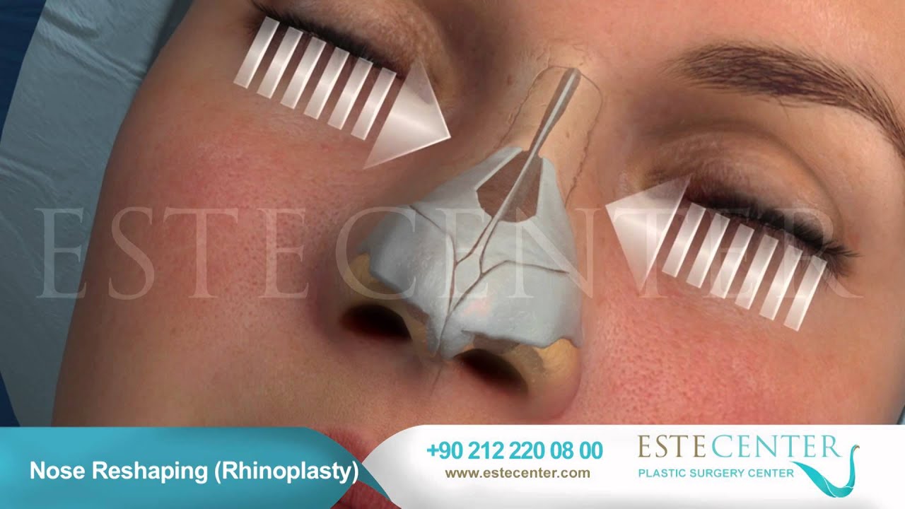 Nose Reshaping Rhinoplasty - Estecenter