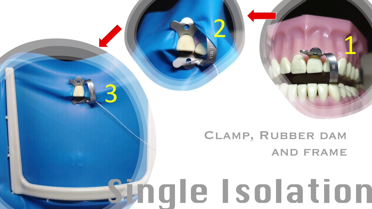 Different Rubber Dam Isolation Techniques, Episode 1 by Dr. Ida Viloria, DMD, Phd