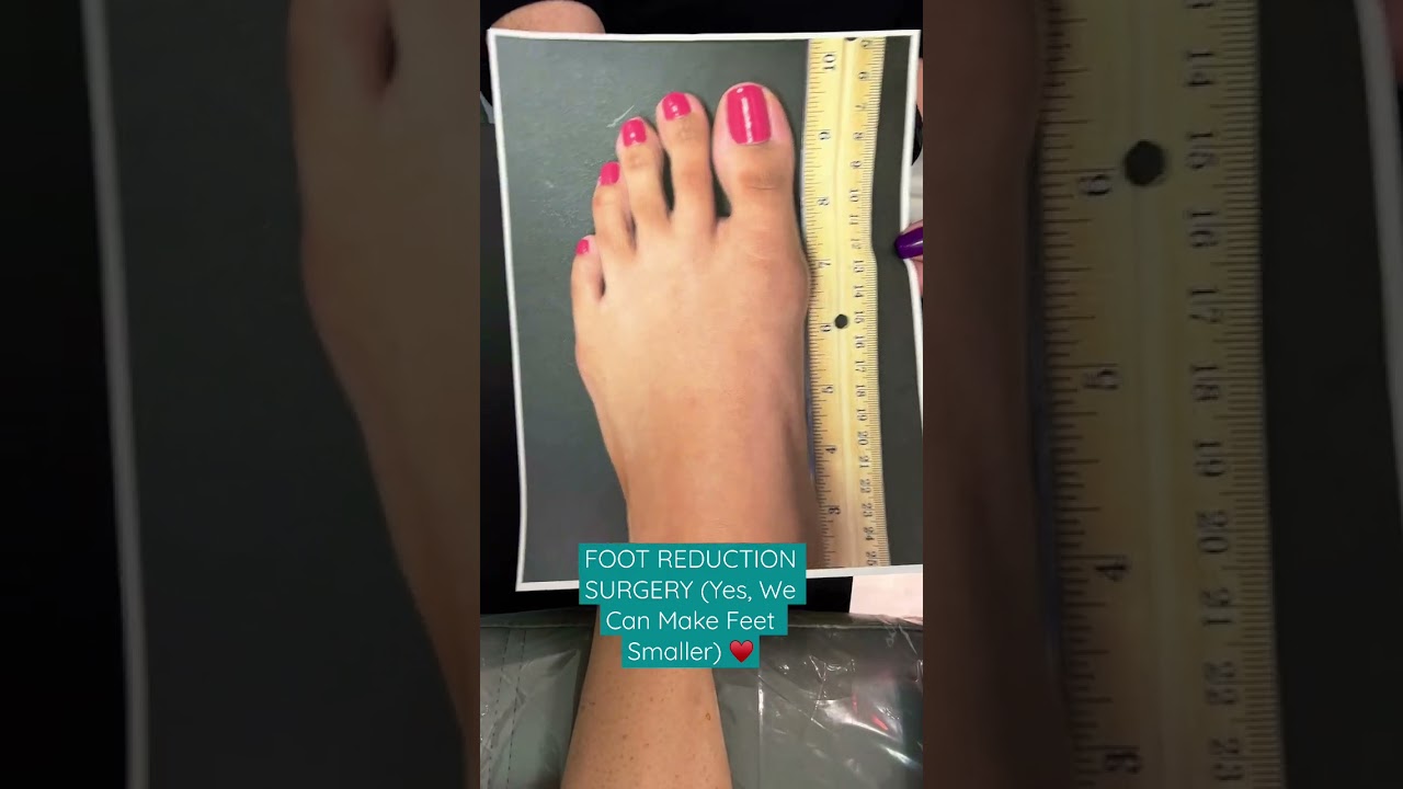 SURGERY TO MAKE FEET SMALLER 💥#shorts #cosmeticfootsurgery