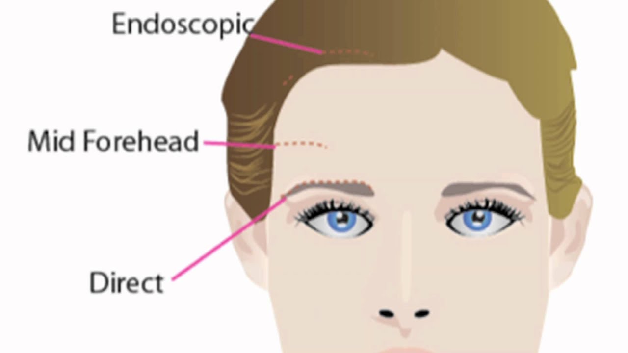 Browlift Approaches | Brow Lift Surgery with Dr. Buonassisi at 8 West Clinic in Vancouver BC