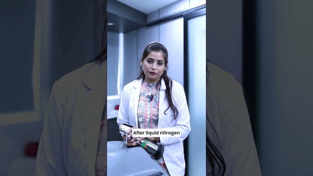 Remove Warts in Minutes!  | Cryotherapy Explained by Dr. Komal Ahuja