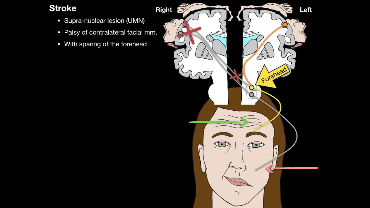 Bells Palsy and Stroke