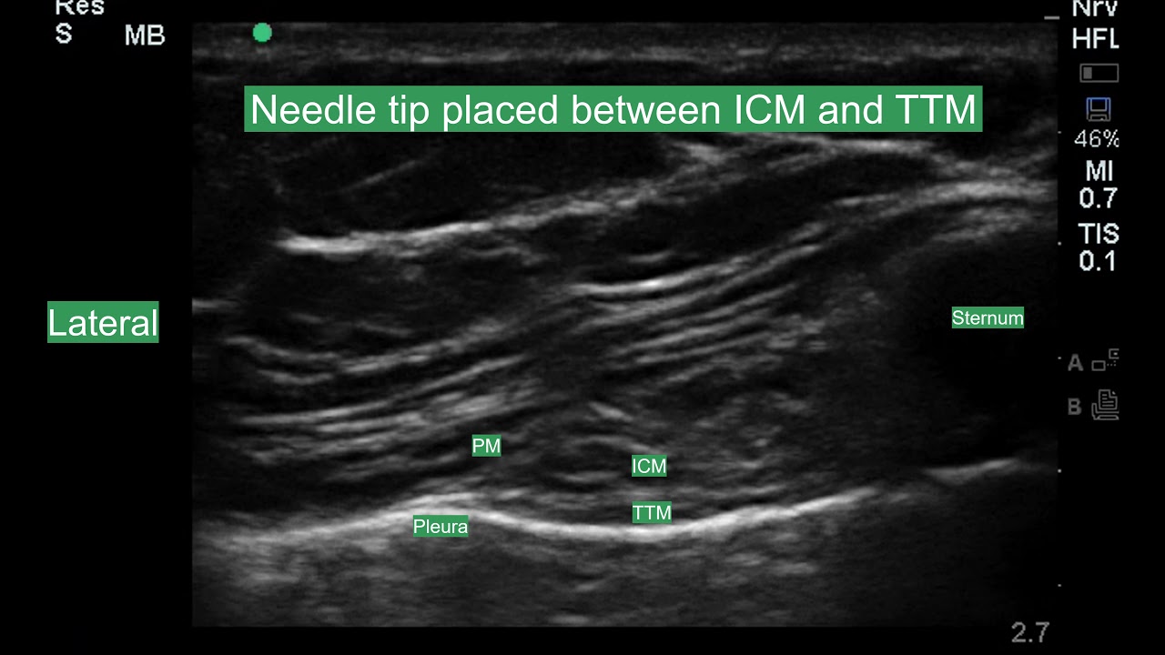 Transversus Thoracic Plane Block