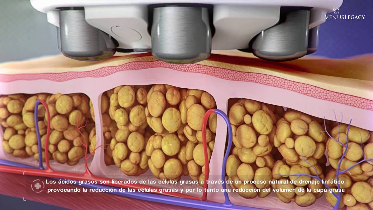 Venus Legacy™, en Suomi Centro Médico Estético.