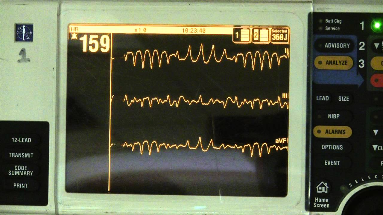 Torsades de Pointes