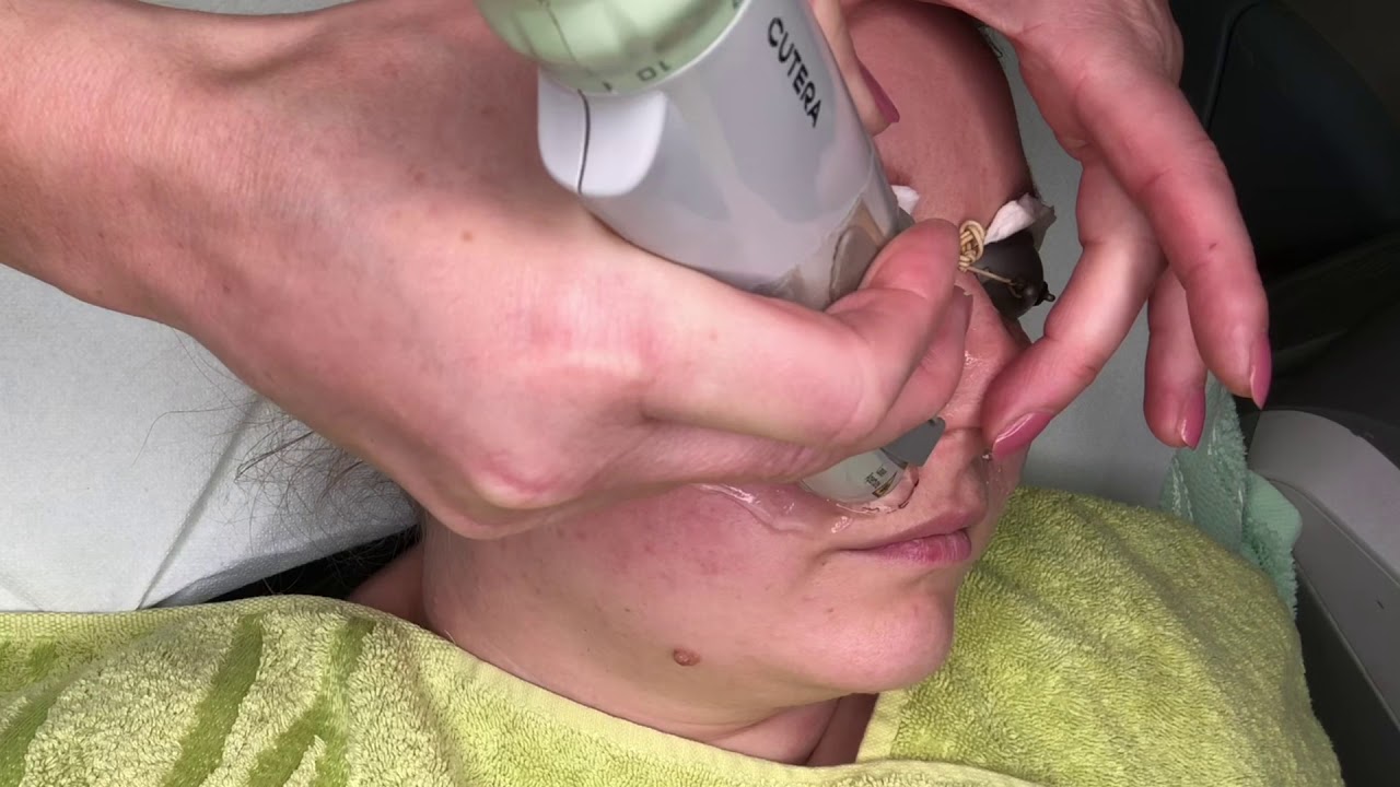 Facial redness Reduction and Laser Vein Removal with Cutera Nd YAG Laser and Limelight