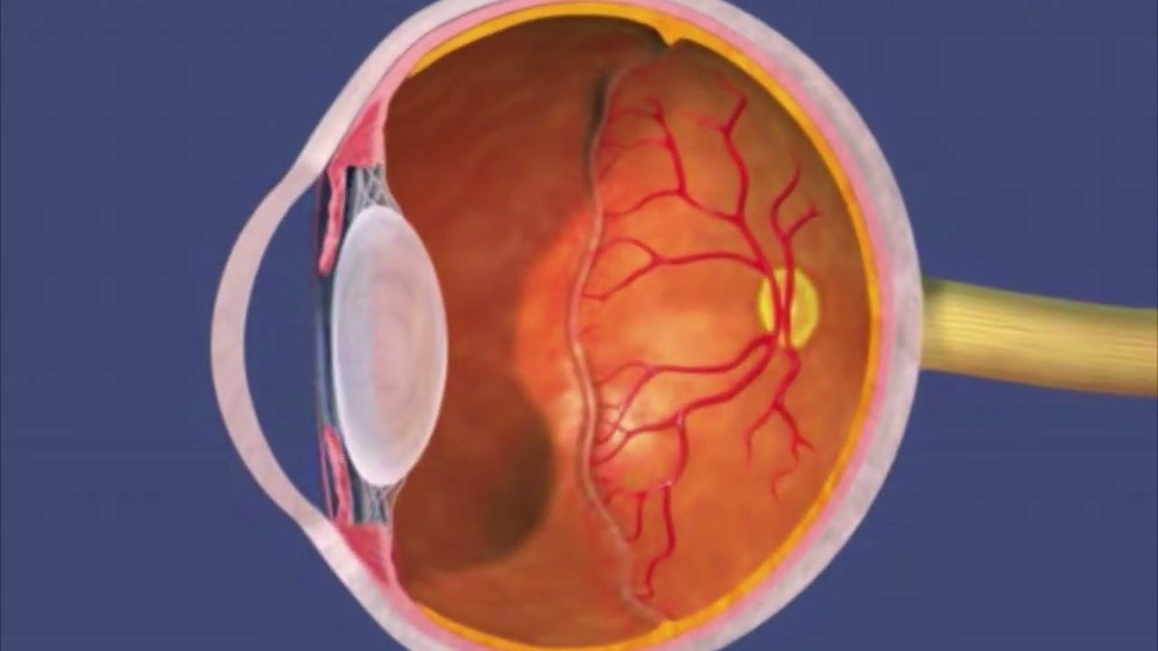 Animation: Retinopathy of Prematurity