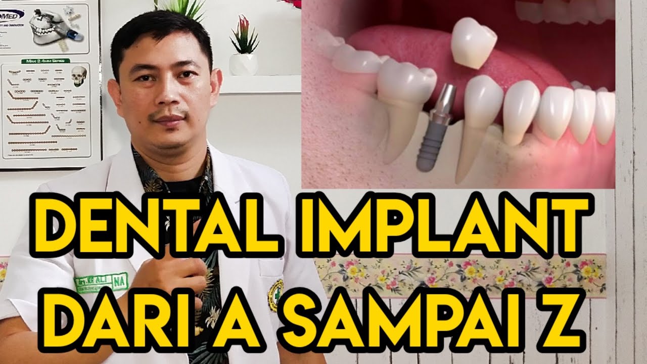 Proses pemasangan implan gigi-gigi implan-implant gigi