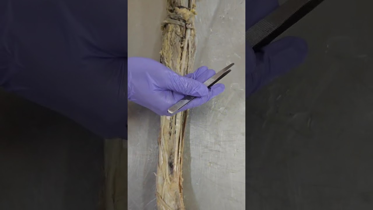Ulnar nerve 