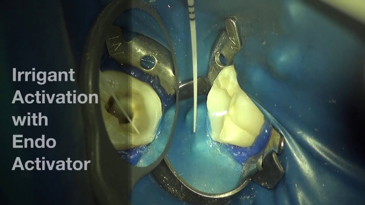 Activation of Endodontic Irrigant Solution - Endo Activator