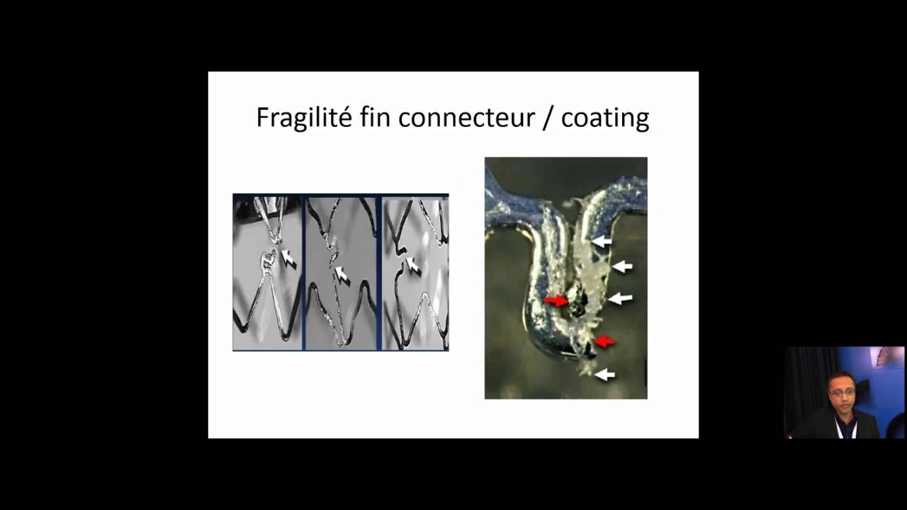 Nouvelle génération de stents actifs : Jusqu’où affiner la maille ?