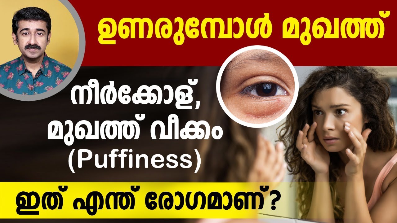ഉണരുമ്പോൾ മുഖത്ത് നീർക്കോള്.മുഖത്ത് വീക്കം.(Puffiness) ഇത് എന്ത് രോഗമാണ്. മുഖത്തെ നീര് എങ്ങനെ മാറും?