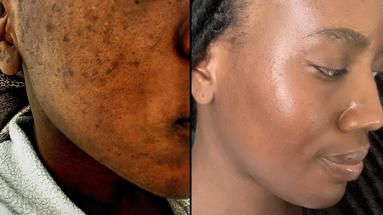How to Get Rid of Dark Spots/Hyperpigmentation FAST (6 Weeks) | MRS ZINYAMA