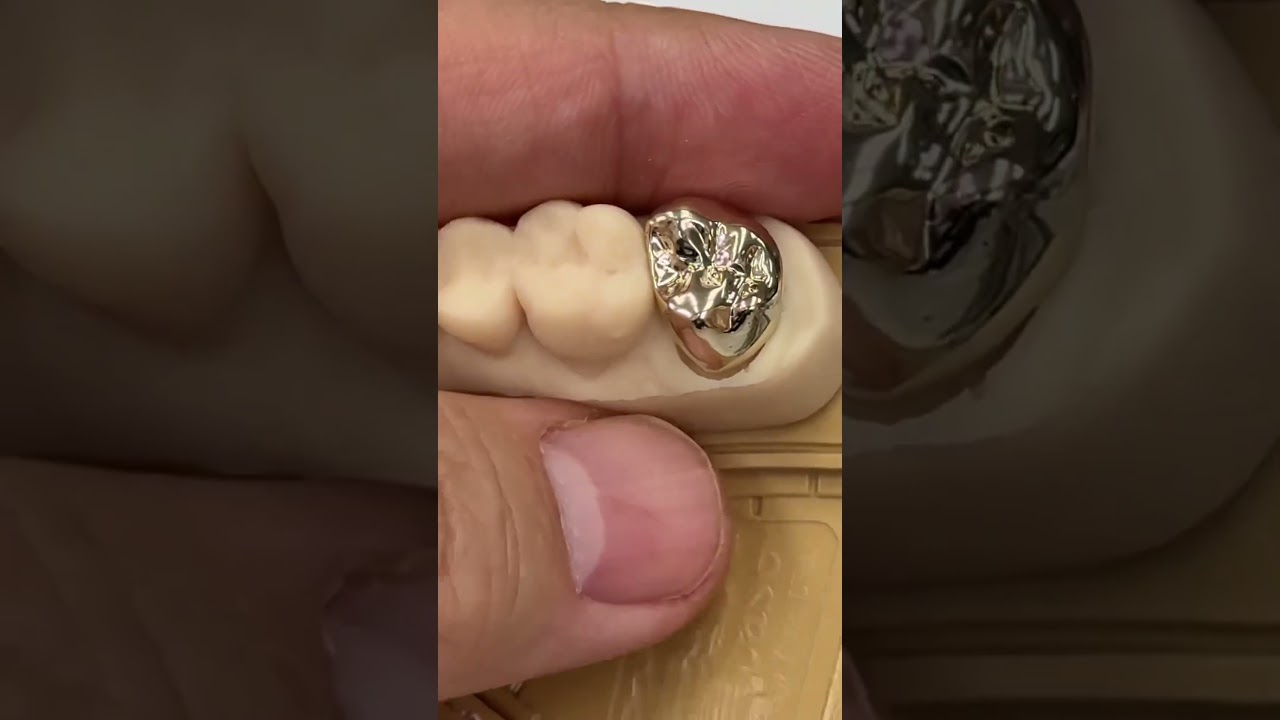 Patient choose Gold crown instead of zirconia @EnvisiontecMain #envisiontec