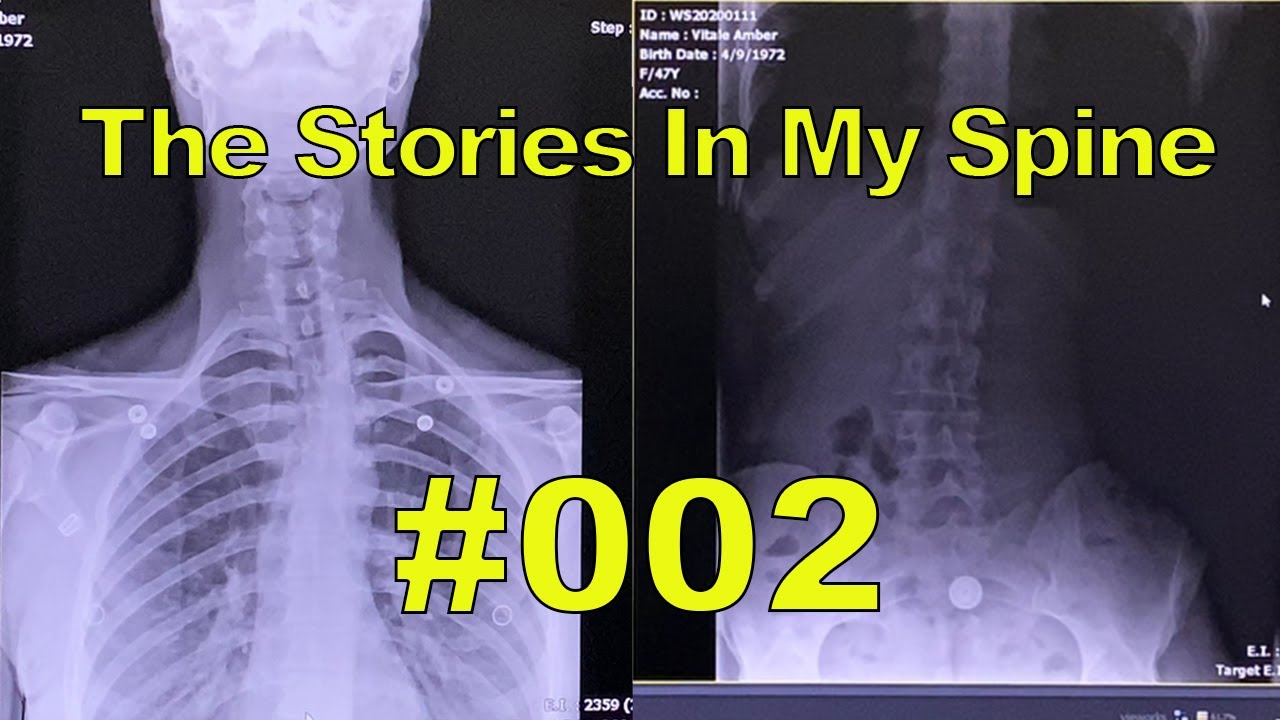 I'm TWISTED!!! - Is This My Spine??? My Chiropractic Journey #002