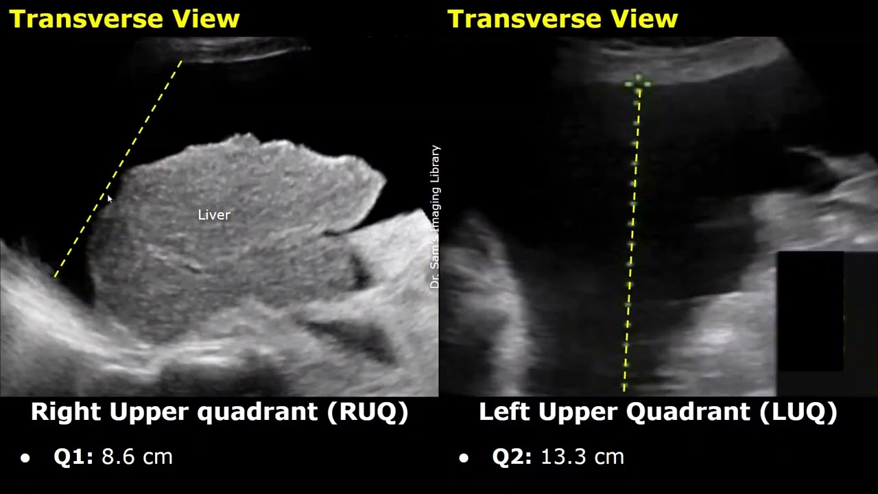 How To Measure Ascites Index On Ultrasound | Mild, Moderate & Large | Ascitic Fluid Measurement USG