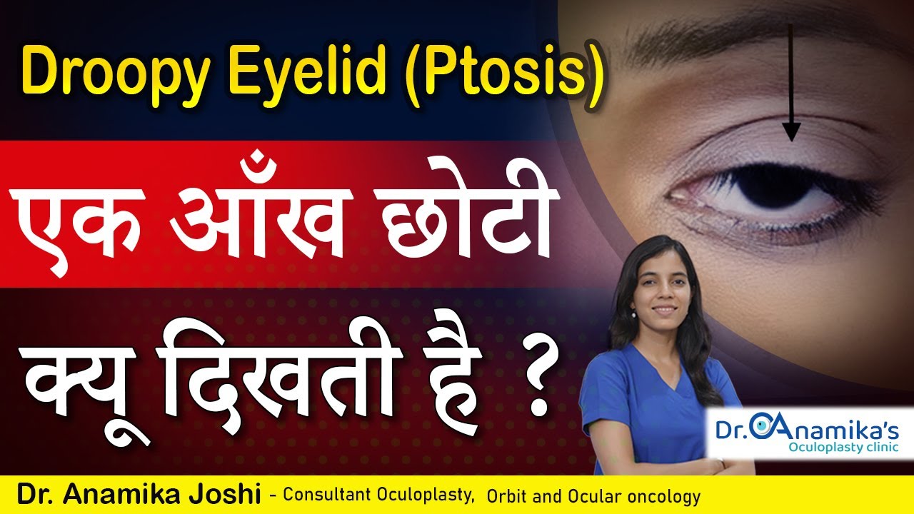 एक आँख छोटी क्यू दिखती है? | Droopy eyelid  | | Dr Anamika Joshi