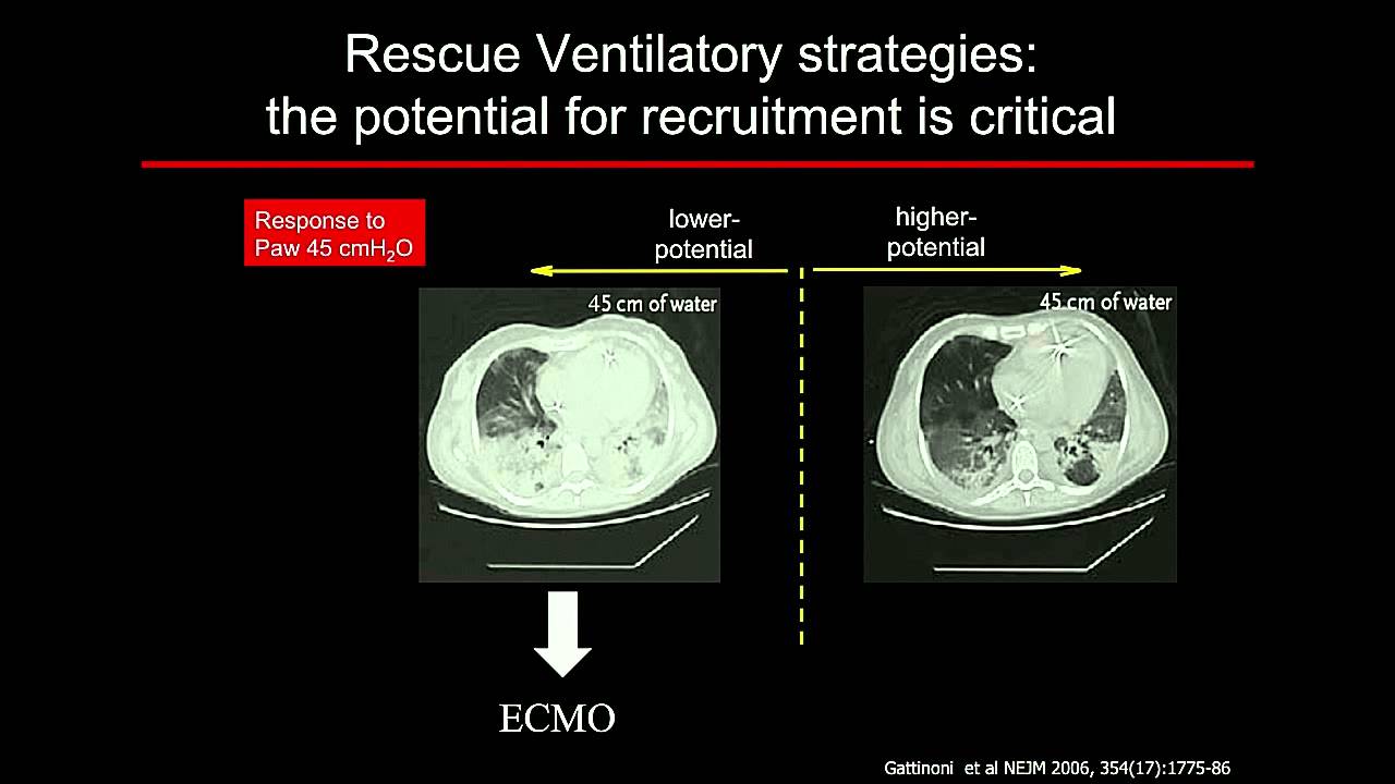 Measuring (and interpreting) Transpulmonary Pressures by Dr Salvatore Grasso MD.
