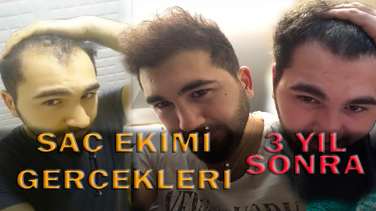SAÇ EKİMİ HAKKINDA GERÇEKLER - SAÇ EKİMİ 3. YIL  - hair transplant facts  #saçekimi