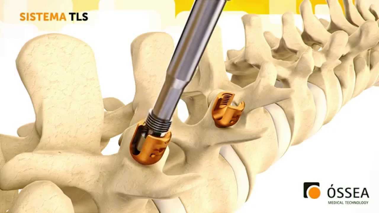 Técnica Cirúrgica - Sistema TLS - Óssea