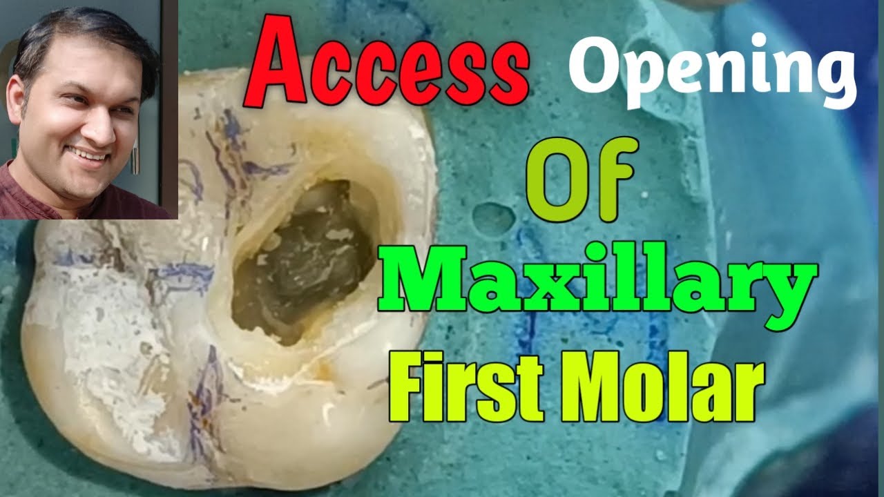 Access opening of maxillary first molar || most simple way to locate the canals || first step of RCT