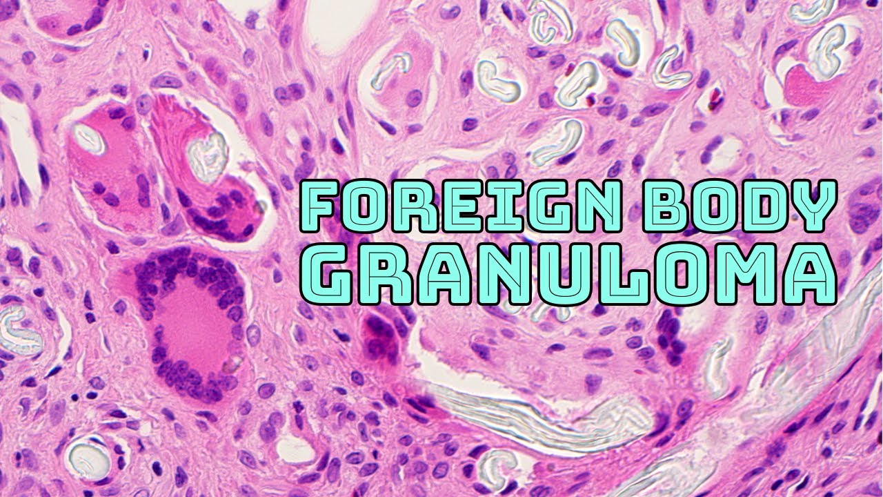 Foreign body granuloma & foreign body giant cells with gauze (pathology histopathology histology)