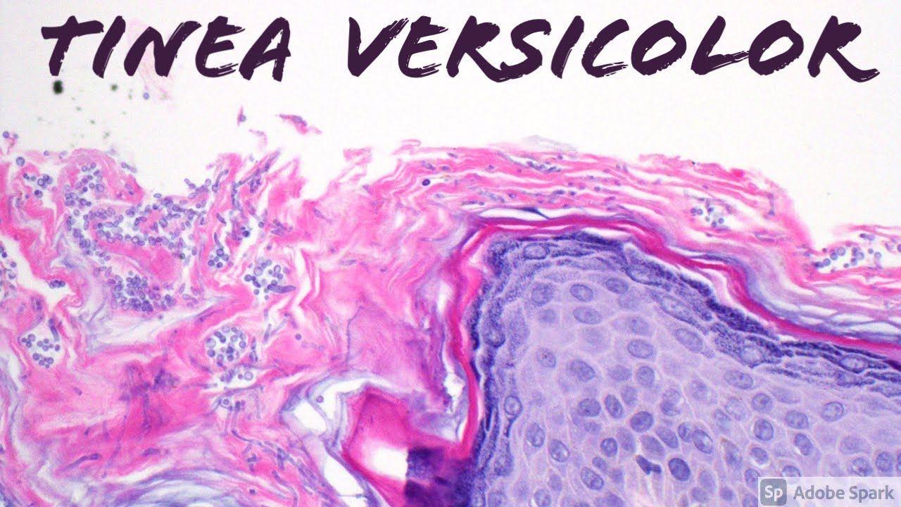 Tinea Versicolor/Pityriasis Versicolor (Malassezia aka Pityrosporum Skin Infection) Dermatology
