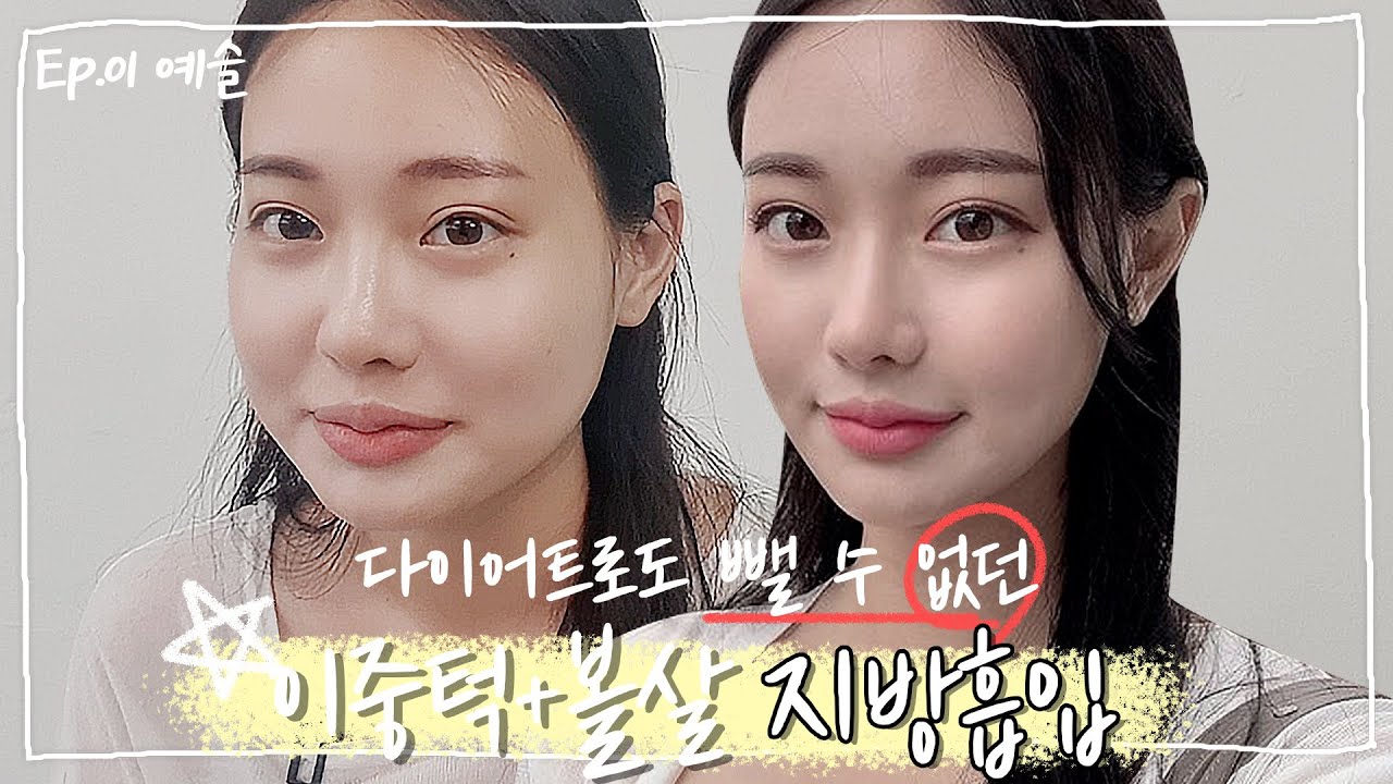 [슬2 Vlog]얼굴지방흡입하고 역대급 청순미모로 사람들의 눈을 홀리다...✨ 수술 다음날 드라마틱한 턱라인에 놀래서 한말은? (최고의 리액션 영상)😎
