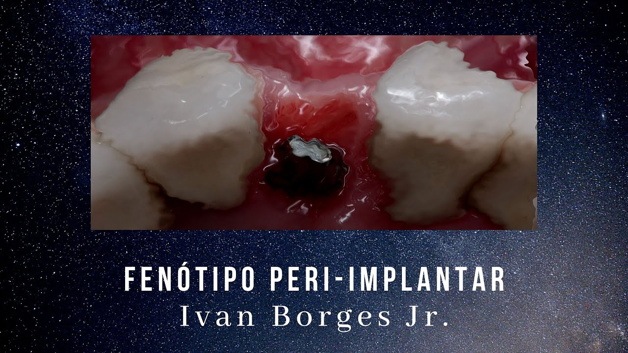 Fen&oacute;tipo Peri-implantar