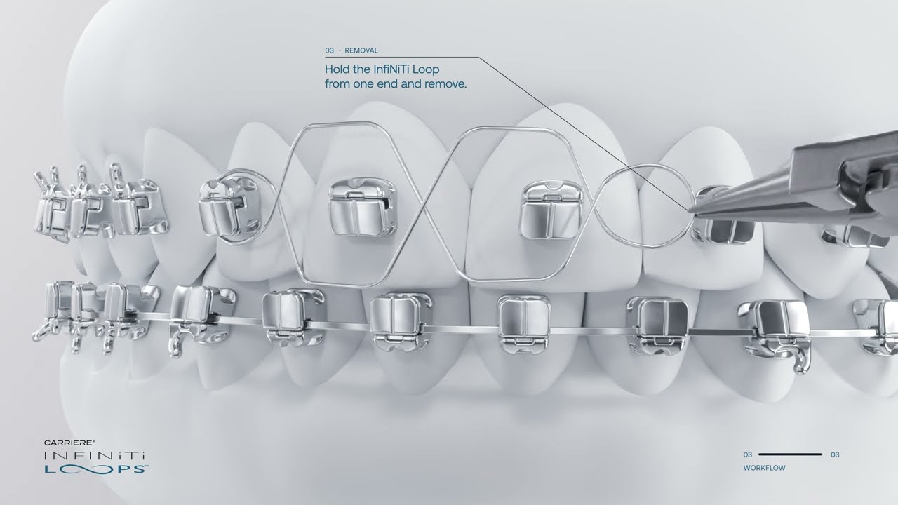 Carriere InfiNiTi Loops Workflow