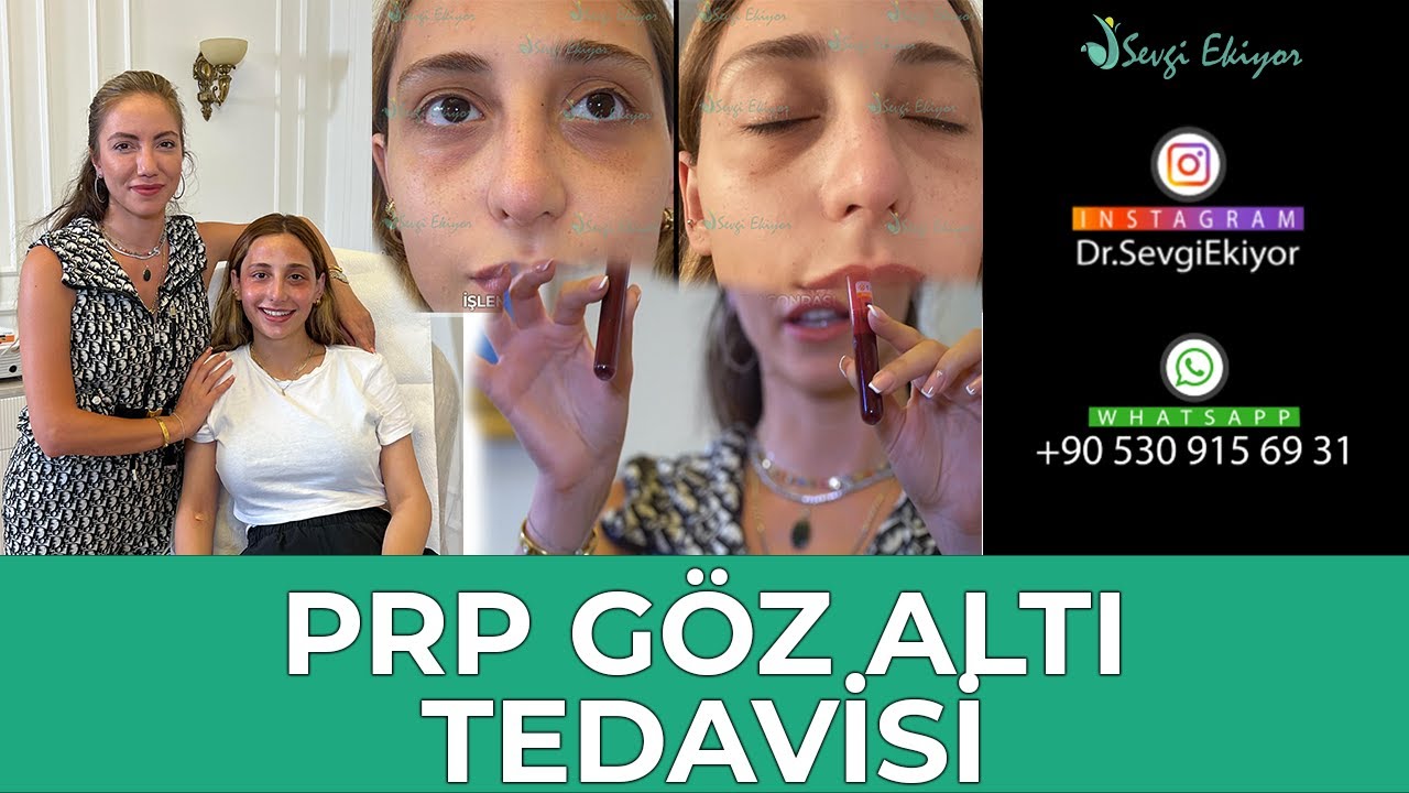 PRP İle Göz Altı Morluklarından Kurtulun !