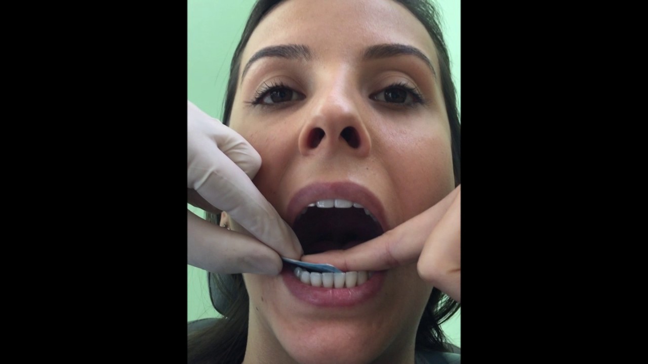 Técnica periapical da Bissetriz para região de Caninos Inferiores