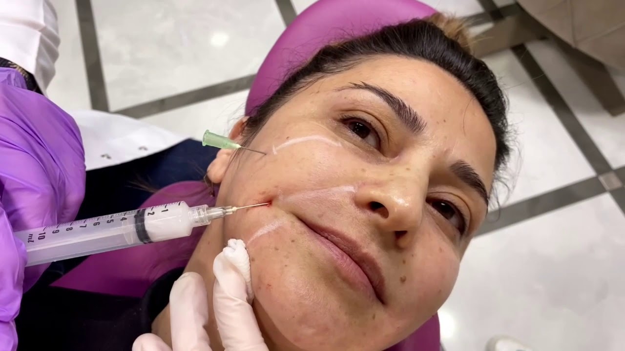 HYDROXYAPATITE FILLER & LIP FILLER