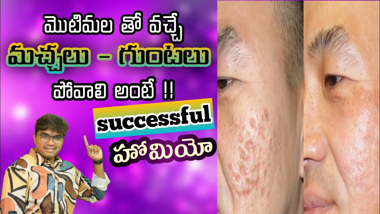How To Remove Acne Scars On Face Acne Scars Homeopathy Treatment మొటిమలు మచ్చలు పోవాలంటే