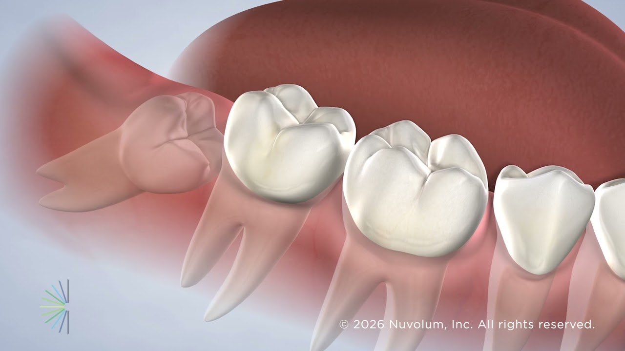 Wisdom Teeth Removal in St. Petersburg, FL