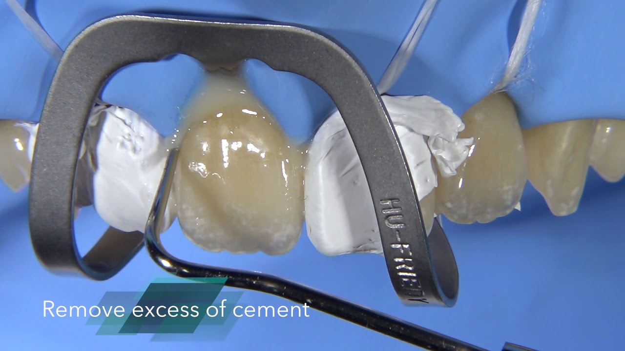 Veneer cementation with the resin cement G CEM LinkForce