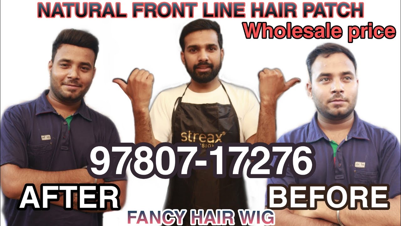 NATURAL FRONT LINE HAIR PATCH  JALANDHAR PRICE CALL 97807-17276 #frontlinehair #hairpatch #hairwig