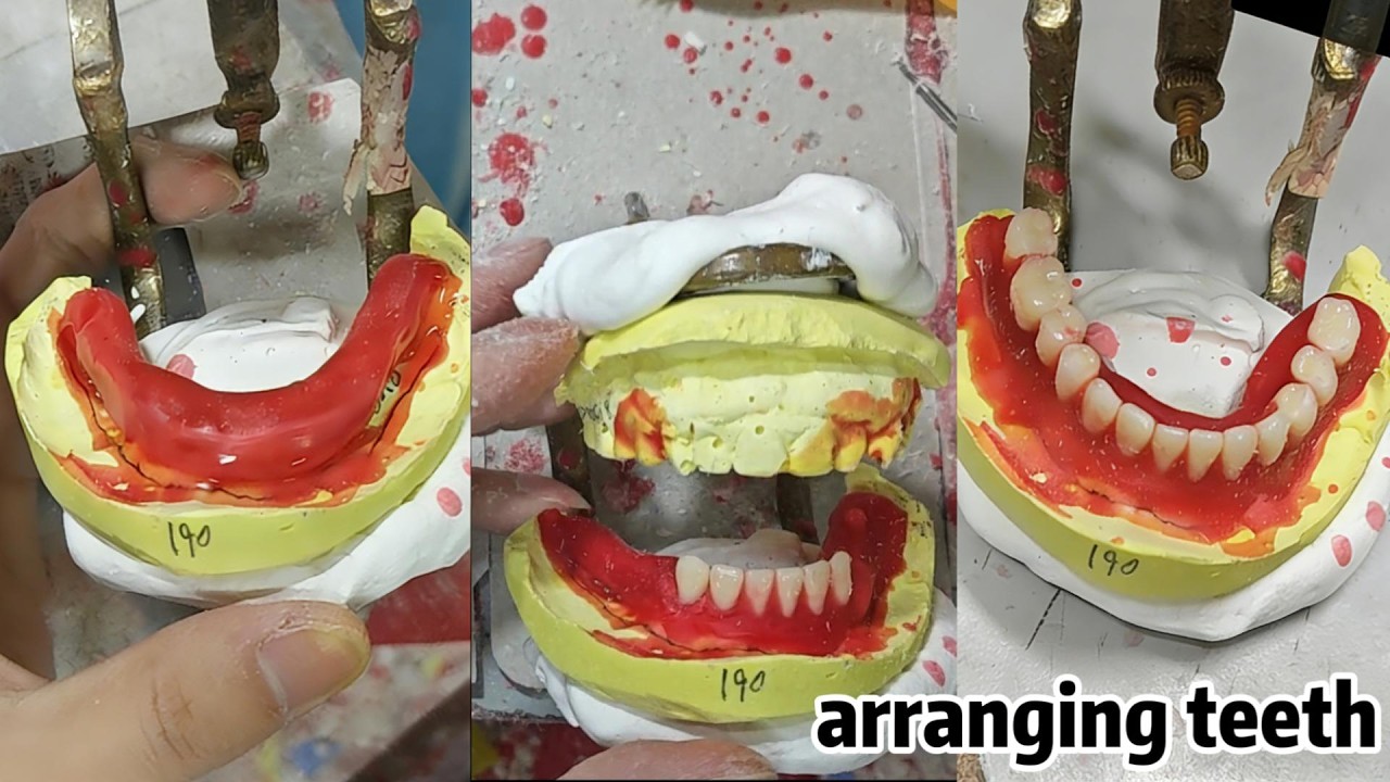 I Finished Arranging Teeth in 5 Minutes – Here's How I Did It!#DentalLab #FastDenture #Dentistry