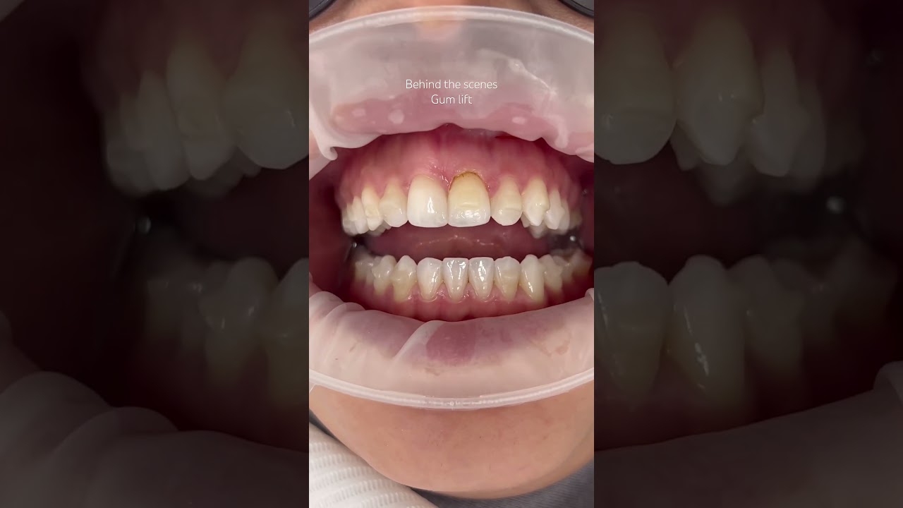 Behind the scenes of a gum lift by Dr. Sonnie 👏 #bettersmile #gummysmile #lifetimesmiles