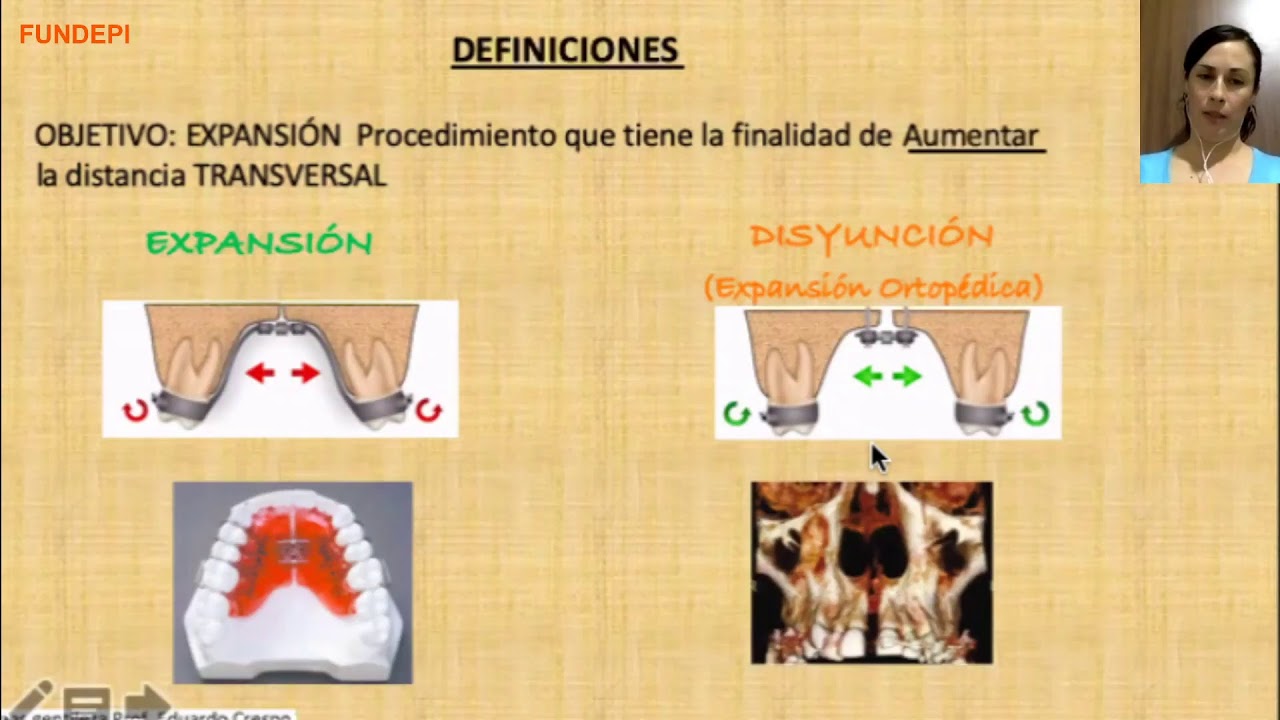 Disyunción maxilar en edad infantil, adolescente y adulta