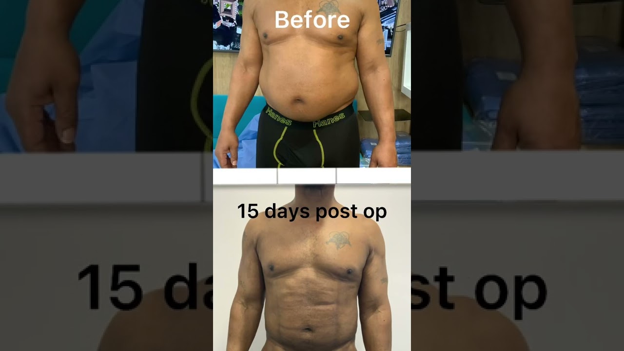 MEN'S LIPOSUCTION + J PLASMA (Before and After Results) 15 Days Post Op - Dr. Carlos G&oacute;mez