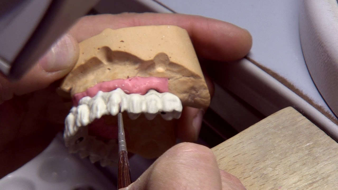 Ricostruzione metallo ceramica - Rossini Laboratorio