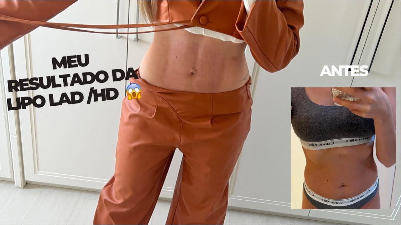 MEU RESULTADO DA LIPO LAD NA JK!