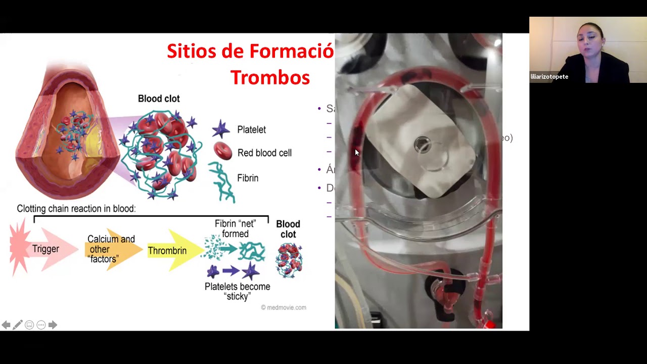 Anticoagulación en TRRC