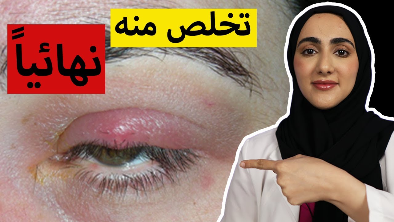 علاج الكيس الدهني / ضبضوب العين.. الحل الاكثر فعالية | د ايمان الحمادي