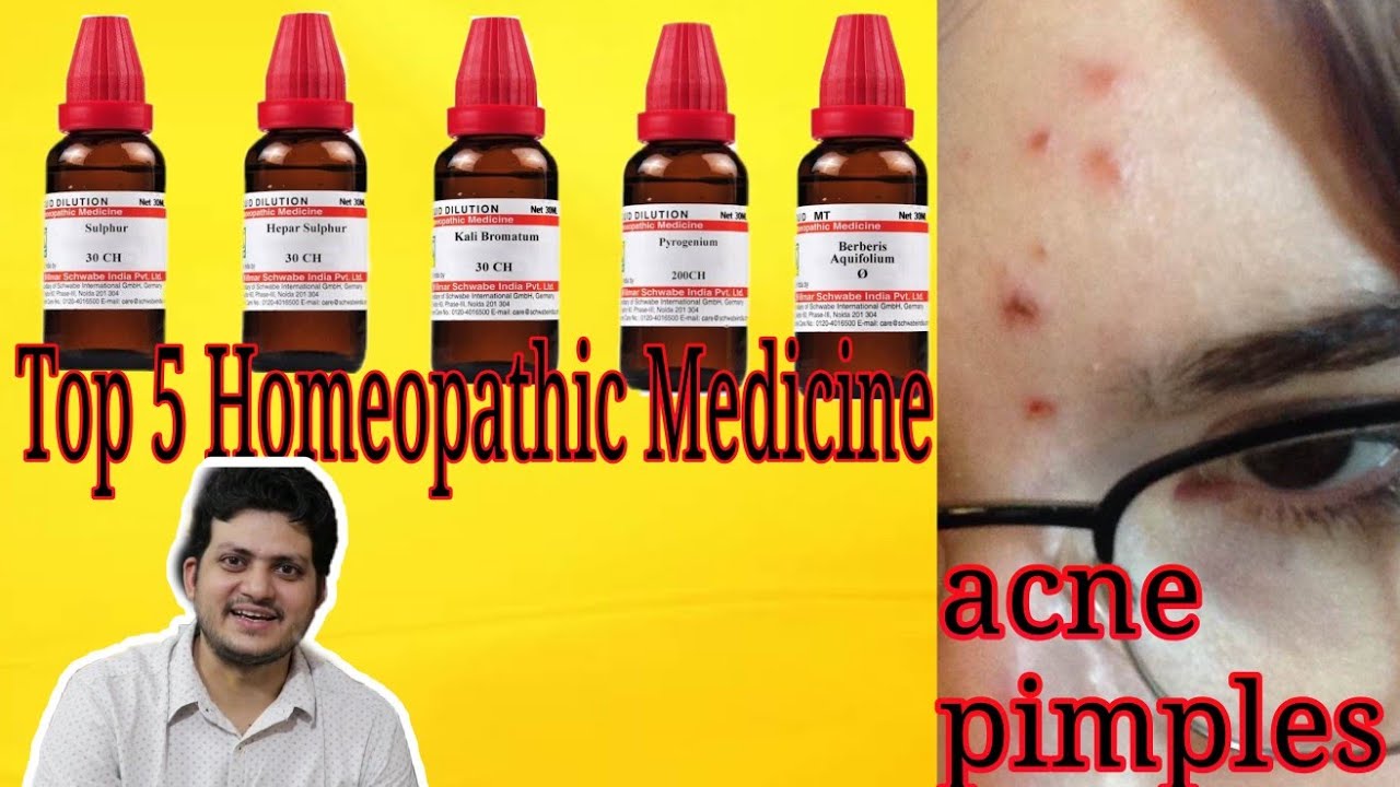पिंपल्स की पांच बेहतरीन होम्योपैथिक दवा ! Top 5 Homepathic medicine for acne & pimples ?